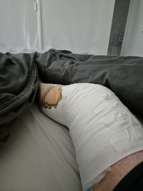 verband na de eerste nacht thuis