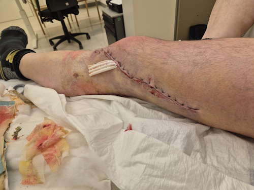 de wond met drain zonder verband
