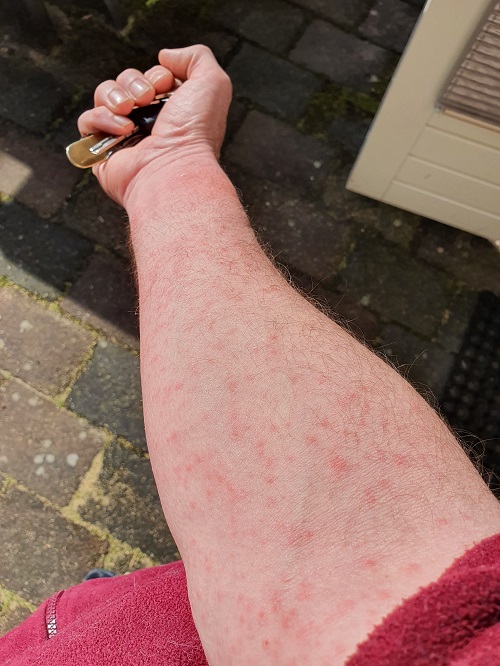 allergie eikenprocessierups